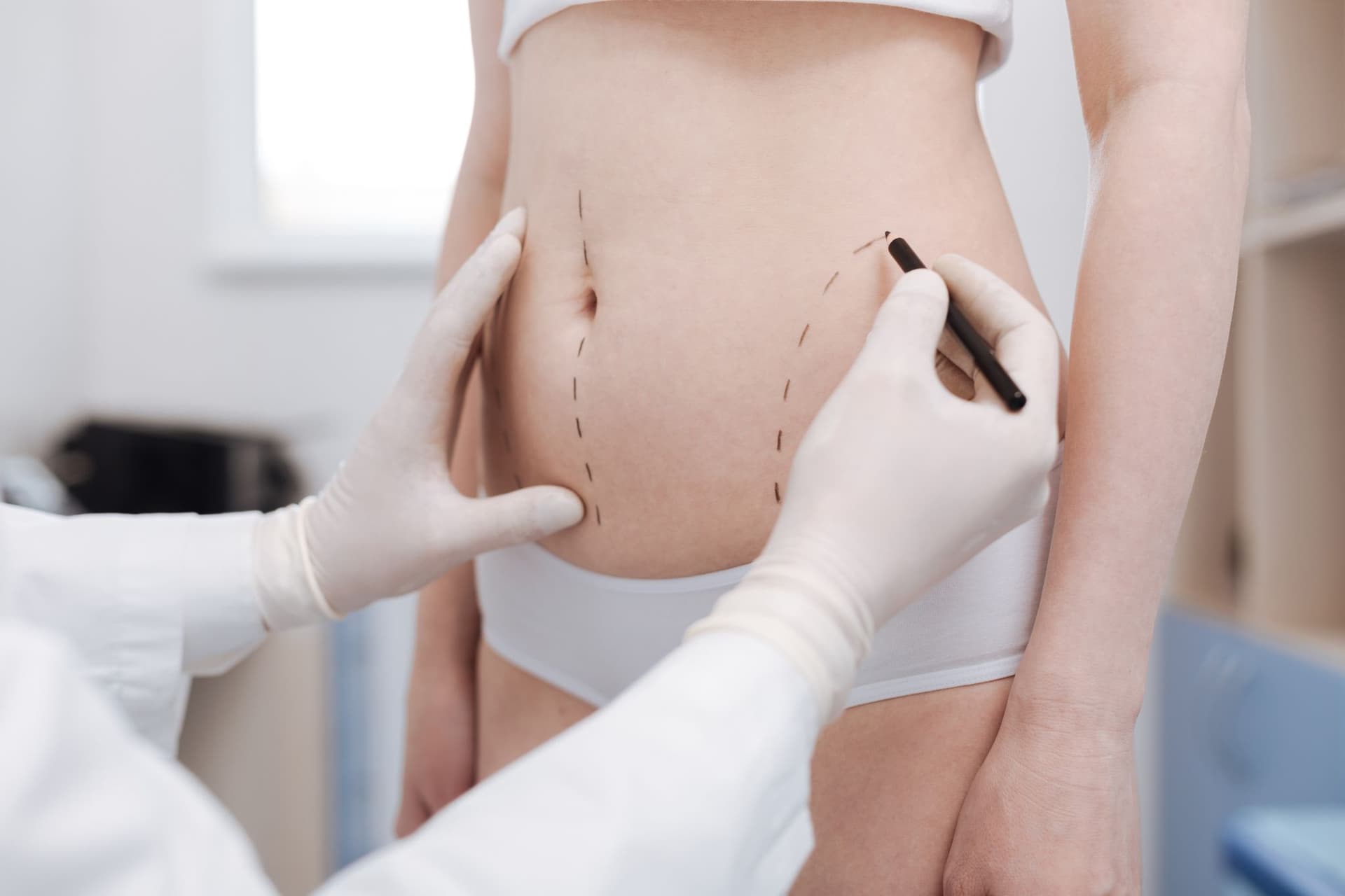 Proč pacienti pochybují o trvalosti liposukce – a jak dlouho skutečně vydrží její výsledek?
