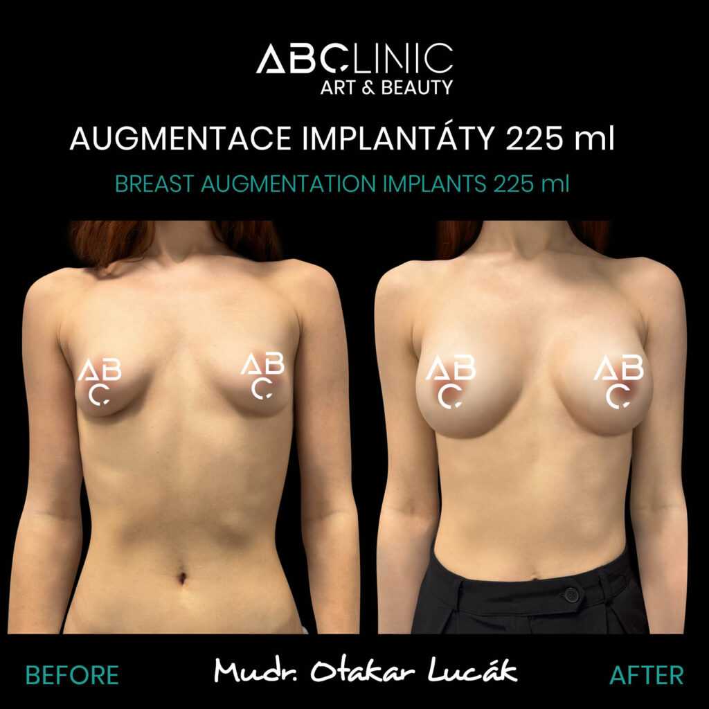 Augmentace implantáty z ABClinic