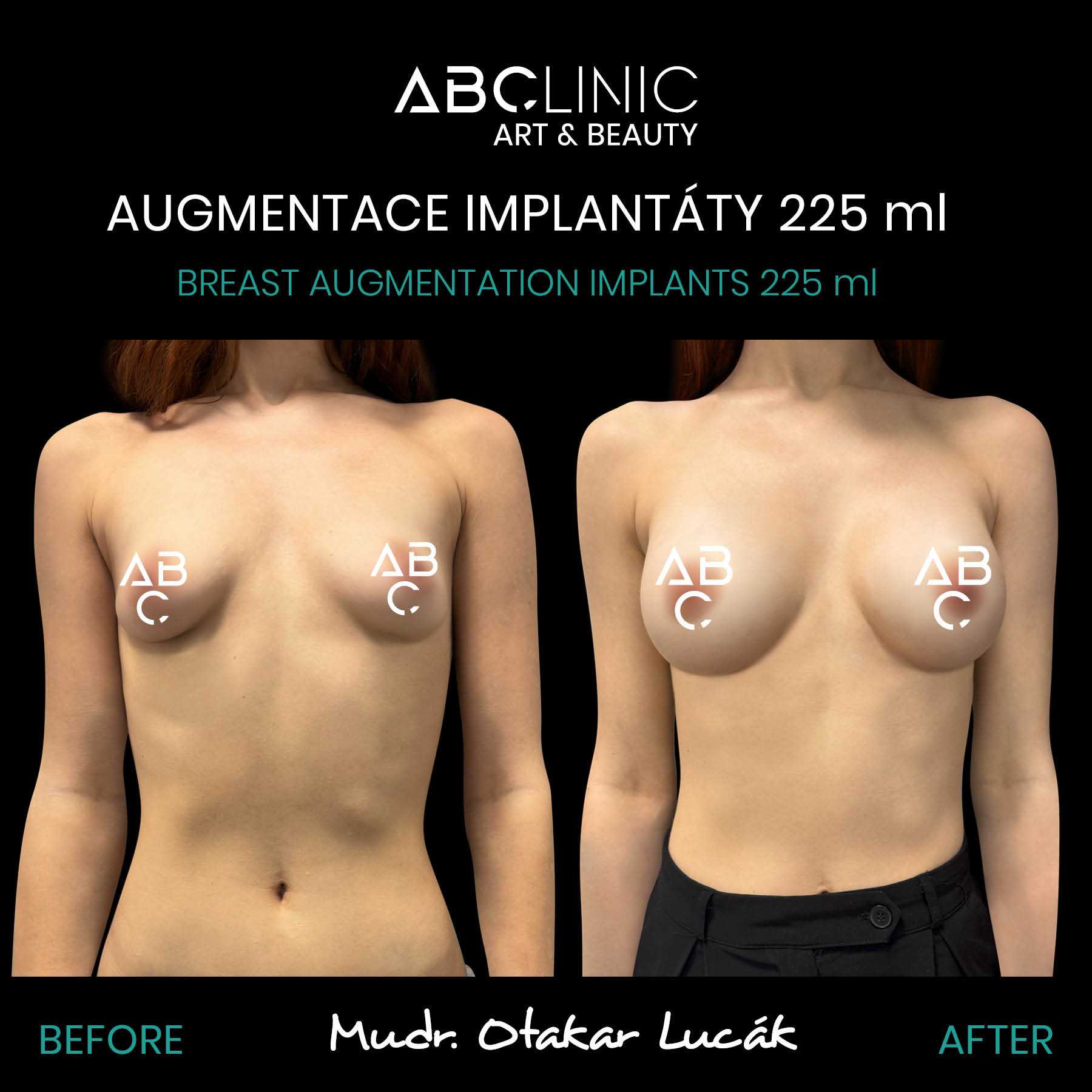 Augmentace implantáty z ABClinic