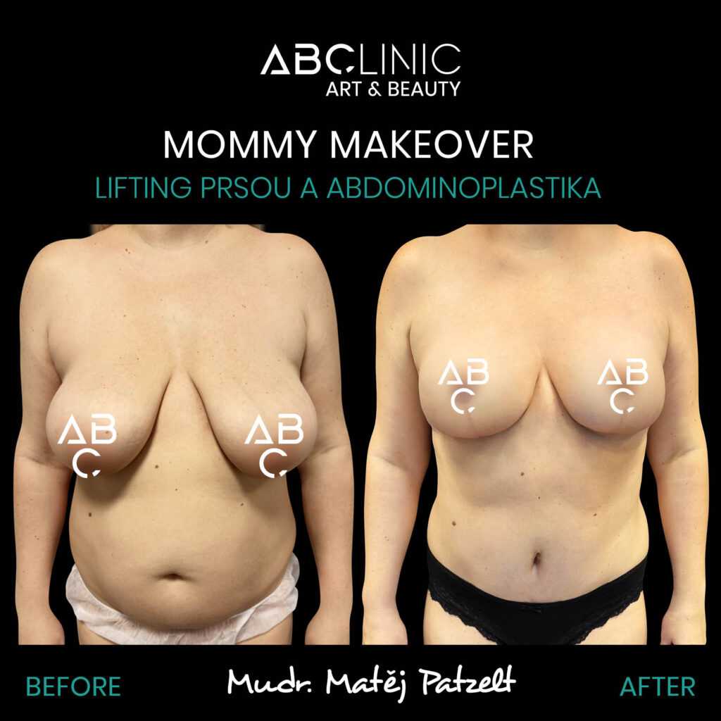 Mommy Makeover z ABClinic