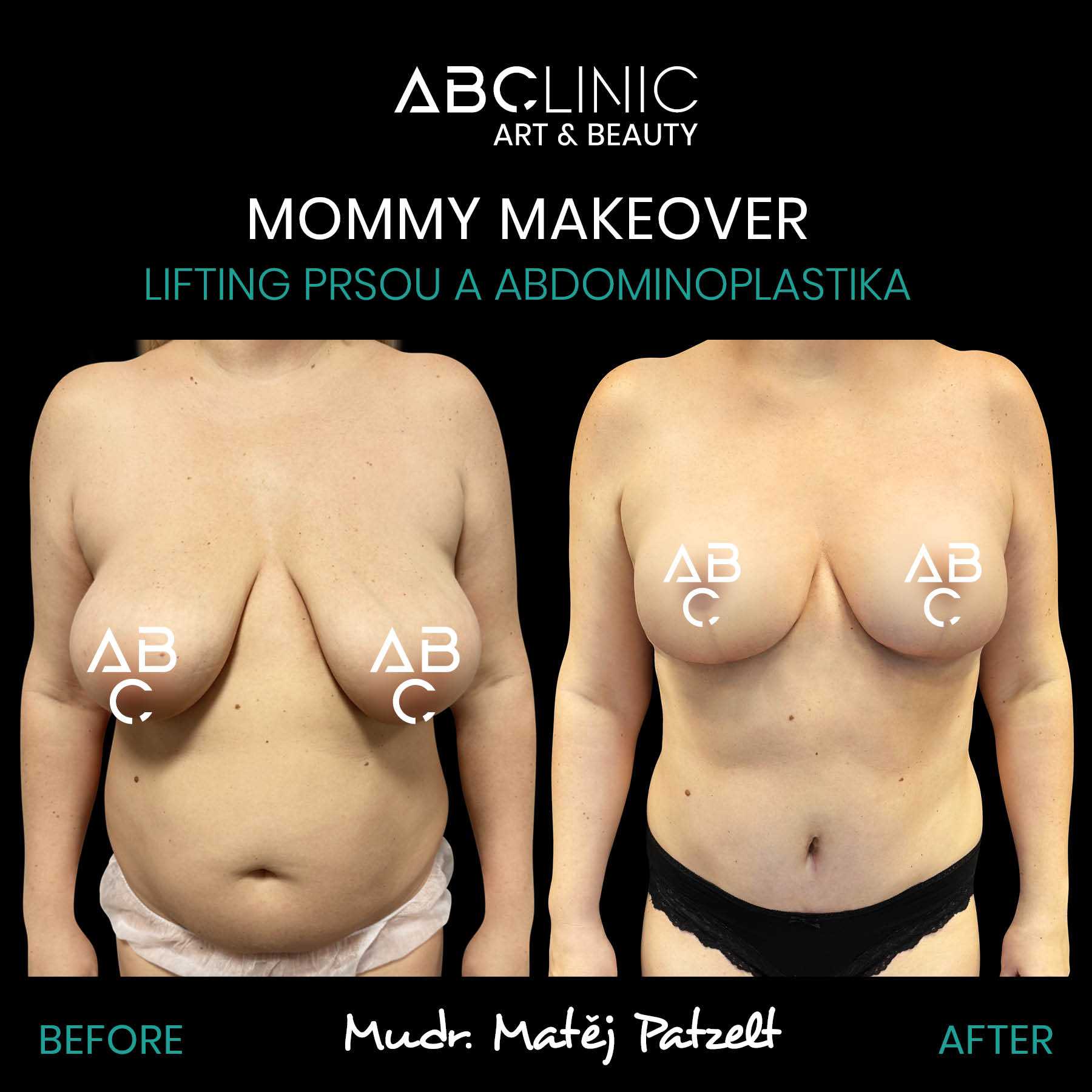 Mommy Makeover z ABClinic